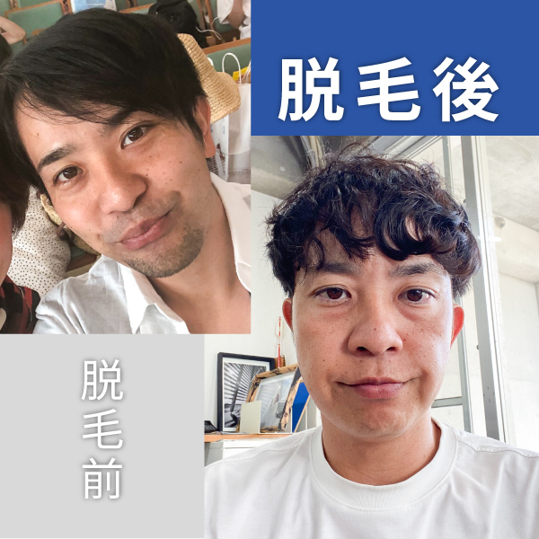 ヒゲ脱毛10回目のお客様